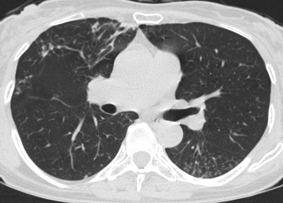 5-mm section thickness, 70 ma) show bronchiectasis and small centrilobular nodules or tree-in-bud opacities in the both lungs, especially in the right middle lobe and the lingular segment of the left
