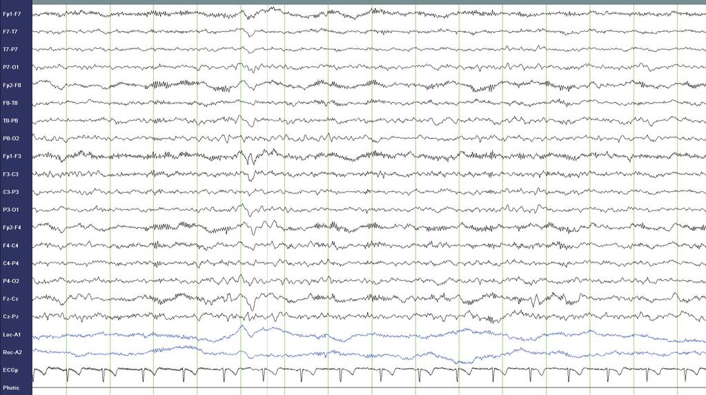 J Neurocrit Care 2013;6:8-15 zure)를 관찰할 수도 있다. 최근 연구에 의하면, 1~3 Hz의 규 고 약물에 반응이 없는 10명(20.4%) 중 2명(4.