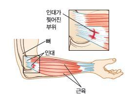 테니스팔꿉증과골퍼팔꿉증 tennis & golfer elbow(lateral/medial epicondylitis) 가쪽관절융기염은손목폄근근육들이공통적으로이는곳 (origin) 인위팔뼈의가쪽위관절융기 (lateral epicondyle)