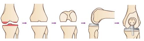 뼈및관절질환 관절염 osteoarthritis 뼈관절염은관절의통증과변형을일으키는질환으로퇴행성관절질환 (degenerative joint disease) 으로알려져있다.