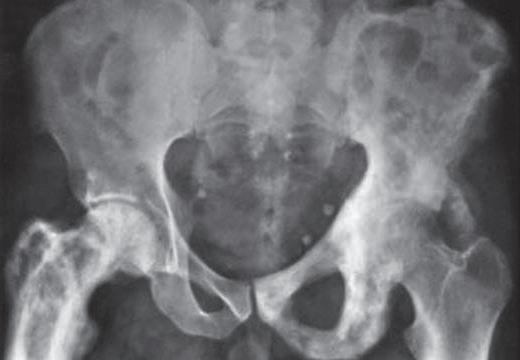 변형성골염 osteitis deformans 파제트병 (Paget disease) 이라고도불리는이질환은변형성뼈염, 뼈흡수후뼈형성이반복적으로과도하게일어나는것으로,
