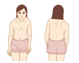 선천성위쪽어깨뼈 congenital high scapula, sprengel s derformity 어깨뼈가선천적으로정상위치보다 2~10 cm 위쪽에위치하는기형이다. 한쪽어깨만올라올수도있고, 양쪽어깨모두올라올수도있다.
