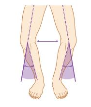무릎과발목의변형 무릎부위의기형에는안굽이무릎 (genu varum), 밖굽이무릎 (genu valgum), 젖힌무릎 (genu recurvatum) 등이있다. 발의기형은상당히다양하게나타난다.