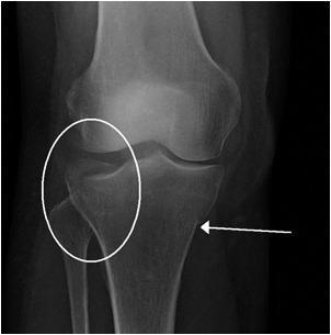 무릎골절 Fracture of the knee