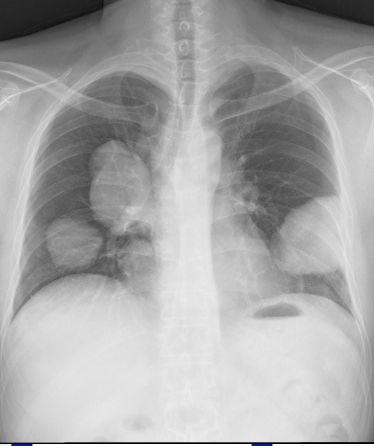 Chest x-ray ³ 2 cm Should be clearly