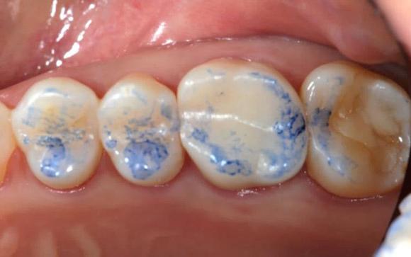 장착후 2 주동안경과관찰하였으며임상적증상이없음을확인하였다. C D E Fig. 6. Cracked tooth case of maxillary right first molar.