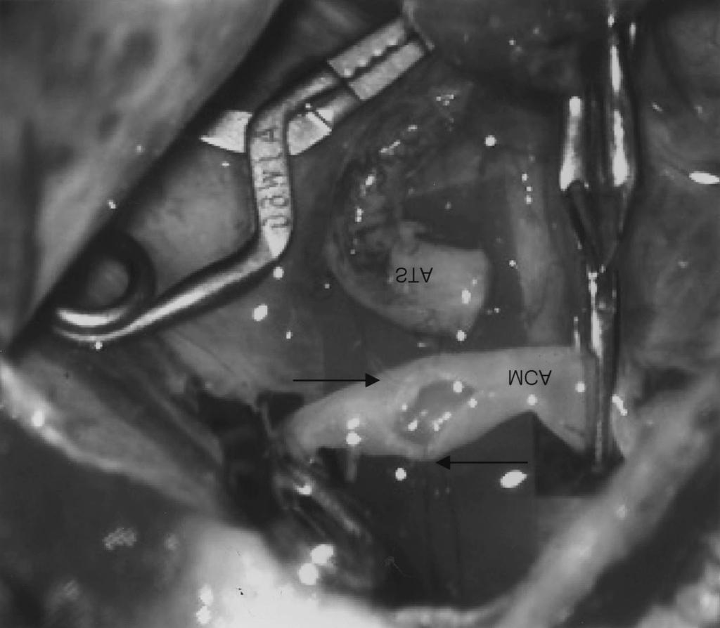 강 성 돈 Fig. 2. Two anchoring sutures (arrows) are placed in the midportion of either anastomotic surface, leaving these sutures untied until individual sutures have all been placed correctly.