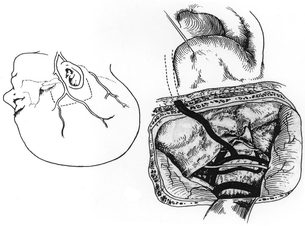 OA to AICA anastomosis. The OA is dissected on the ipsila-teral side, and a suboccipital craniectomy is performed.