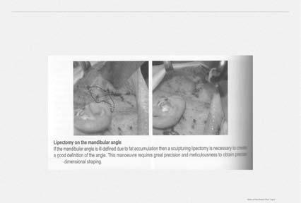 Parotid/Submandibular Gland