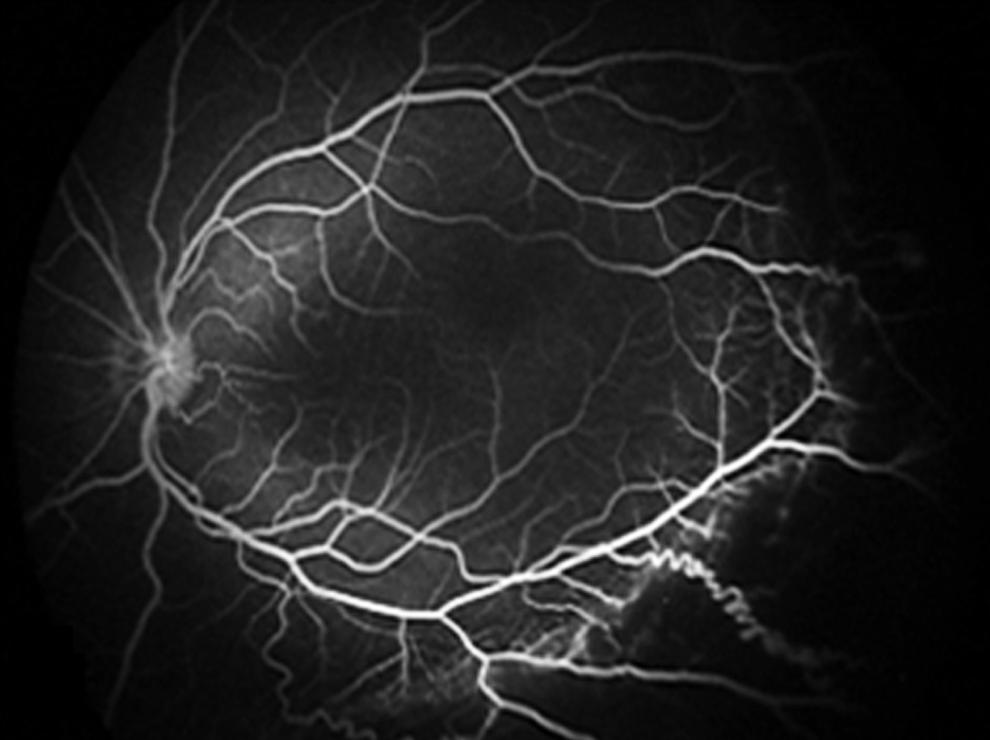 Fluorescein angiogram of the left eye before the laser