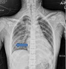 Fig. 5. Pulmonary edema. Chest radiograph shows pulmonary edema in right lung(arrow).