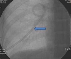 수술은 3 시간 40 분정도걸렸으며, 수액은정질액 1700 ml 교질액 500 ml, radiation 된적혈구농 축액 2