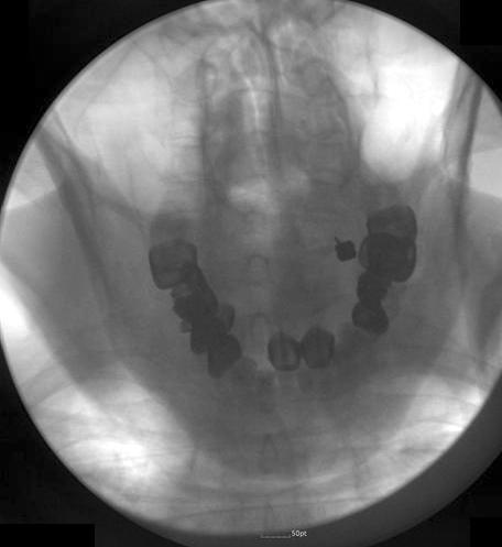 (D) Cervical facet joint injection on the right C6-7: (a) anteroposterior view, (b)