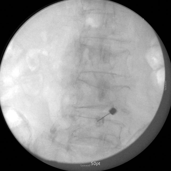 The second needle is approaching to the C5-6 facet joint with the guidance of the