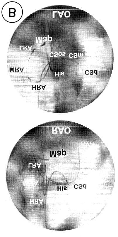 고주파전극도자절제술 (Radiofrequency catheter ablation) Fig. 1. Mapping for the focus of AT in the case 15.