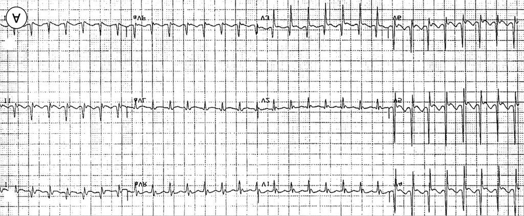 Fig. 5. AT mimicking atrioventricular reentrant tachycardia AVRT utilizing accessory pathway Case 20.