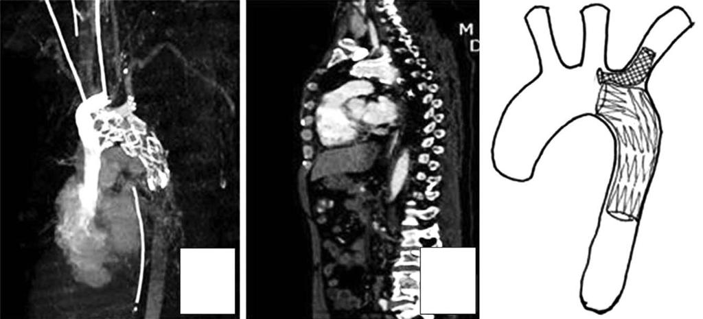 Gwan Woo Ku, et al.: Clinical Analysis of TEVAR in Blunt Thoracic Aortic Injury 간을기준으로손상 16시간전과 16시간이후에수술적치료를시행한군을비교연구한결과에따르면 16시간이전에수술한군이사망률이더높았고, 하지마비가더많았다.