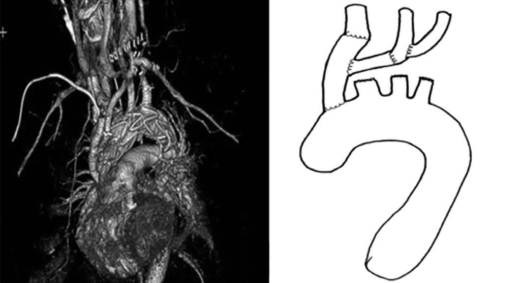 - Journal of Trauma and Injury Vol. 28, No. 4 - TEVAR 시술의제한점은상용화할수있는스텐트그라프트의굵기에제한이있으므로대동맥궁의굵기와스텐트그라프트의안착을위해 15 mm 이상의공간이확보되어야함으로손상부위에서좌측쇄골하동맥사이의간격이 15 mm 이상이어야시술이용이하다.