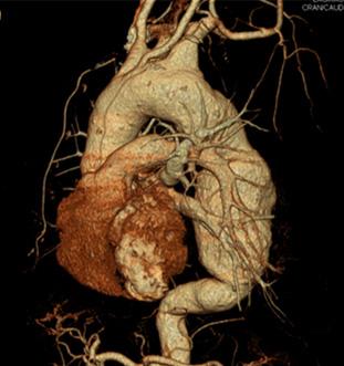 proximal descending thoracic aorta (A, B).