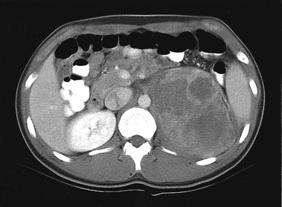 - 대한내과학회지 : 제 70 권부록 2 호 2006 - A B Figure 1. (A) Computed tomographic scan of abdomen shows well defined, rounded mass with heterogenous density in left suprarenal region.