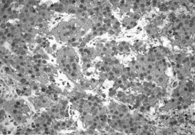 - 배지철외 5 인 : 성인에서진단된신경아세포종 1 예 - Figure 3. Immunohistochemically, tumor cells show diffuse immunoreactivity for neuron-specific enolase (NSE) ( 400) ( 정상 : 0-14) 였으며, 부신피질호르몬검사에서 cortisol (8AM) 21.