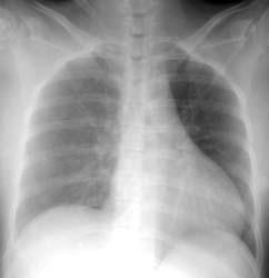 Tuberculosis and Respiratory Diseases Vol. 59. No. 4, Oct. 2005 검사실소견 : 말초혈액검사상백혈구 17,800/mm 3, 혈색소 13.1 mg/dl, 혈소판 50,000/mm 3 였고혈액응고검사상 Prothrombin time(pt) 66.