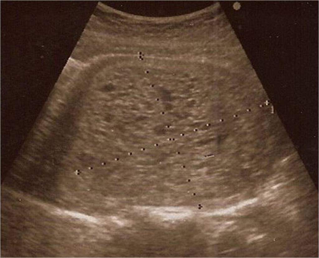 진찰소견 : 내원시혈압 220/130 mmhg, 맥박수 114회 / 분, 호흡수 24회 / 분, 체온 36.4 였고, 급성병색을보였다. 흉부진찰에서양폐야에서수포음이들렸고, 복부진찰에서 Figure 1. Peripheral blood smear findings.