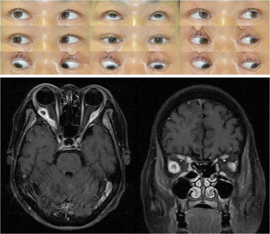 Figure 6. This patient with a history of lung cancer presented with binocular horizontal diplopia and a limitation of abduction in the right eye.