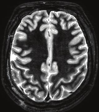 D: Histopathologic finding demonstrates oligodendroglia-like cells and floating neurons in myxoid matrix, indicating dysembryoplastic neuroepithelial tumor (HE, 200).