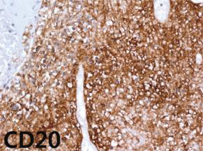 stain, 200), negative for EBV-encoded RNA in situ hybridization ( 200), and