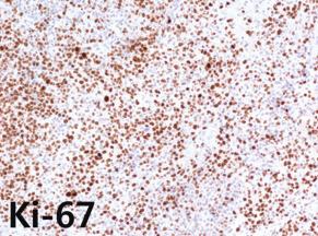 Case 2-1 had pathologic diagnosis as B-cell polymorphic type PTLD.