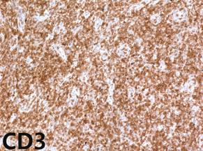 160 mg을 1주일 간격으로 총 4회 정맥 주사하였다. 혈액 EBV 1C and D)이 관찰되었다.