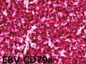 Case 1 3회 주사하였고, 그 후 EBV DNA PCR은 음전되었다.