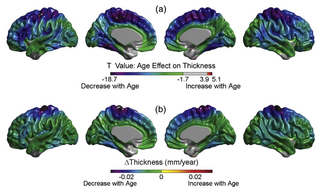 Result (Figure2) 그룹별뇌두께변화통계적분석 결과 : 전나이대를사용한통계적관점에서의나이에따른뇌의두께의변화및변화량
