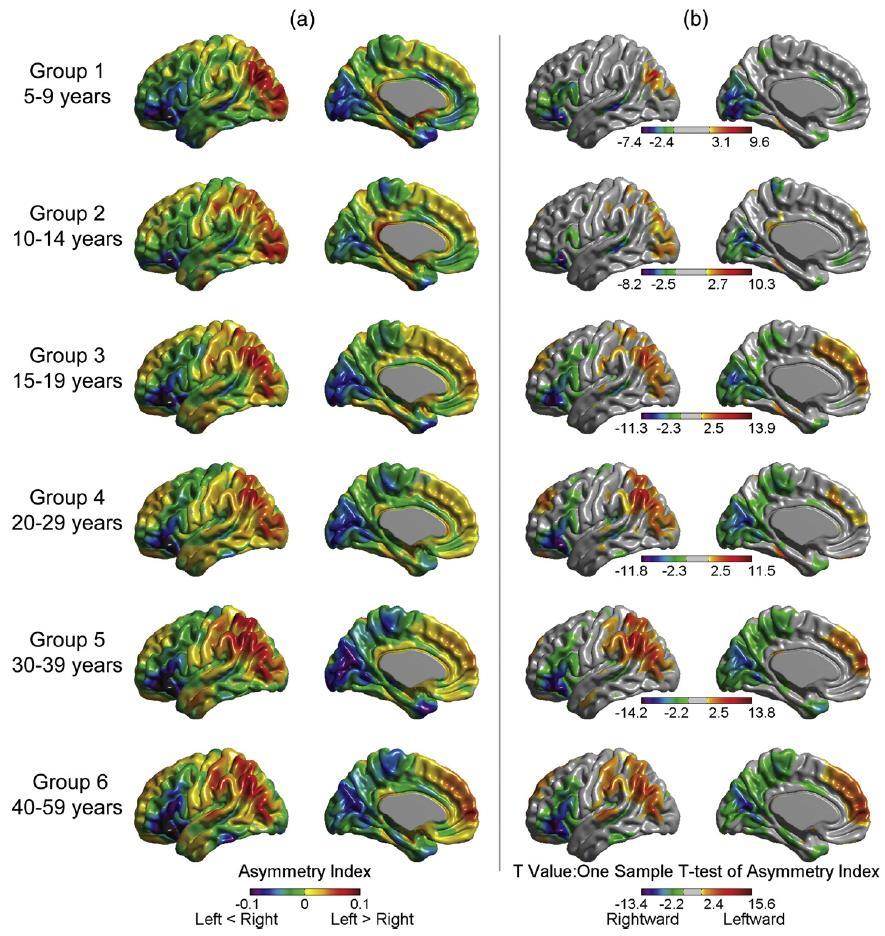 Result (Figure3) 그룹별뇌비대칭성변화량 ( 통계적 ) 가시화 RED : 왼쪽이상대적으로두꺼움 BLUE : 오른쪽이더두꺼움 특징 어릴수록뇌가대칭적임 전