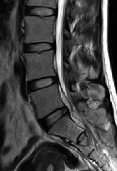 magnetic resonance (C) images showing left S1 nerve root compression due to a displaced S1