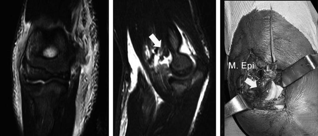 하지만일반적으로부적절한수술적고정으로인해장기간의부목고정이관절운동제한을유발하게된다. 관절구축을피하기위하여조기운동이권장되고이를위해서는안정적인골절의고정및골절치유가우선한다. 신경외과적문제 Fig. 8. Intra-articular loosebody can develop after coronoid tip fracture.