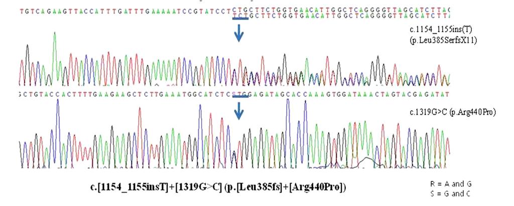 - 조성호외 : PKAN 에서발생한망막색소변성 1 예 - Figure 4. In partial sequence of PANK2 gene, there are c.1154_ 1155 ins(t), c.1319g > C mutation on exon3 and exon 4 (blue arrow).