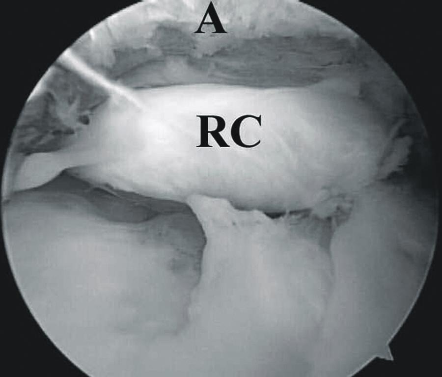 on the articular side of the cuff and (B) a large flap