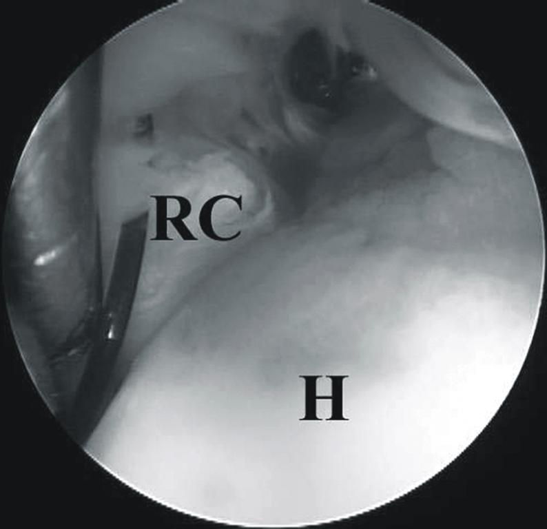RC, rotator cuff; H, humeral head. Fig. 6.