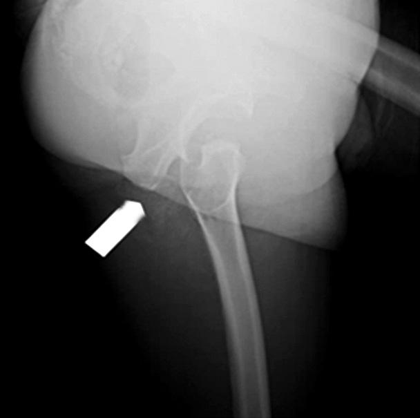(D) Anterior image of dislocation (arrow) of left femur.