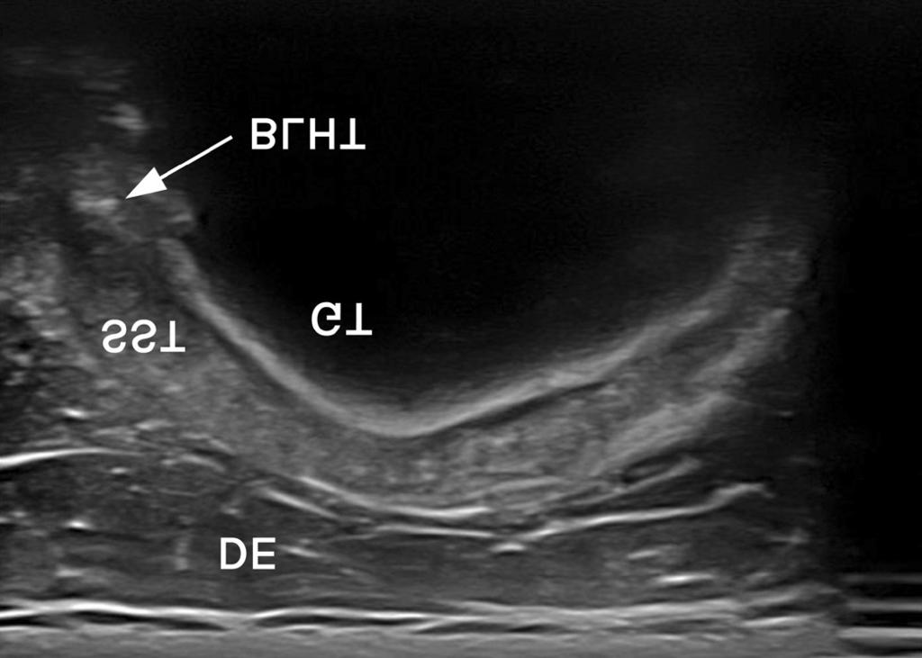 These sonographic images show the grading of the short-axis view of the rotator interval. (A) Grade I, when the border between the BLHT and the SST tendon is not observed prominently.