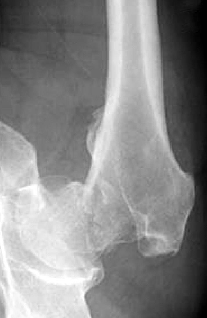2), 동측간부골절이동반되는경우의약 30% 에서진단을놓치는경우가있으니상당히주의하여야한다.
