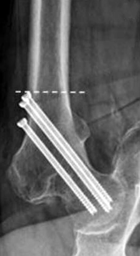 하지만골두하골절이나경부중간골절에서는두고정기구사이에고정력의차이는없는것으로밝혀졌다. 42) Pauwels 3형의골절에서는압박고나사를사용한경우에다발성유관나사삽입술을사용한경우에비해재수술률이 50% 가량감소하였다. 43) 4.