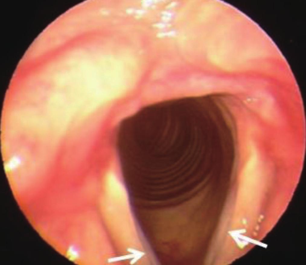 Secondary Sublesional Laryngeal Cyst after PDL Glottoplasty Kim H, et al.