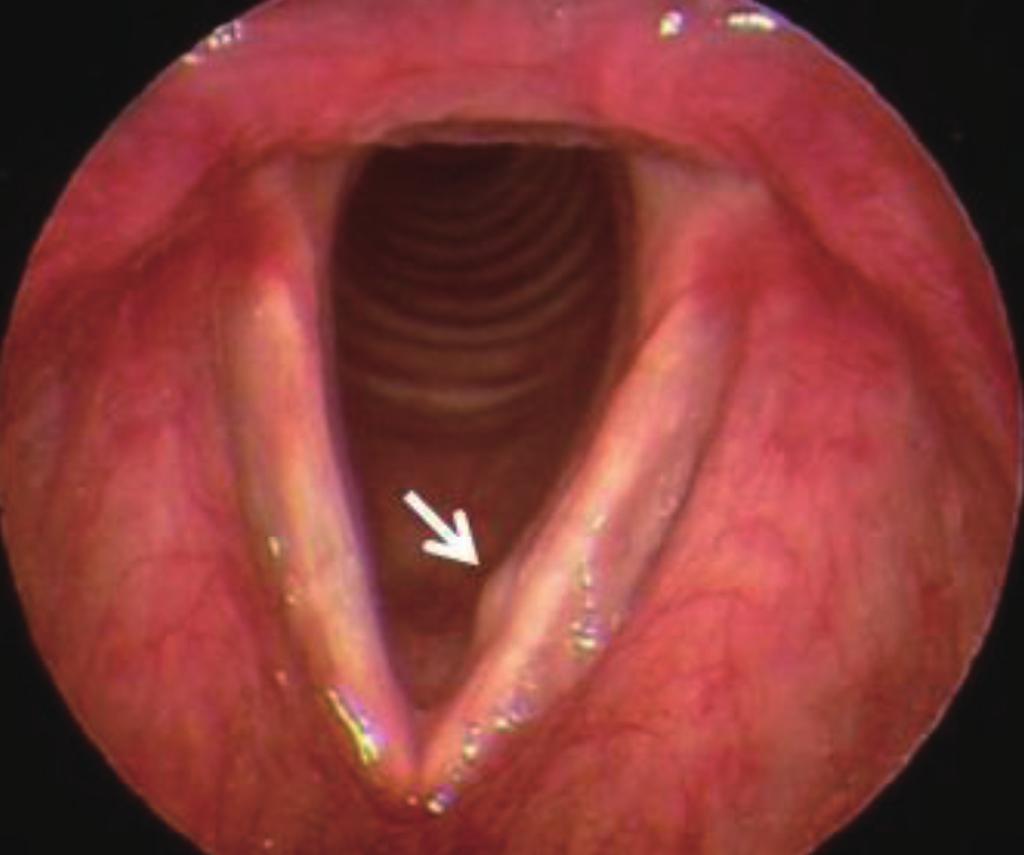 Telescopy shows sublesional laryngeal cyst on the anterior-portion of left vocal fold (arrow: sublesional laryngeal cyst).