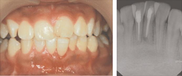 치아우식소견은보이지않았고환자가기억하는별다른외상병력은없었으며약 6개월전에입술과해당부위잇몸이많이부었던경험이있다고하였다.