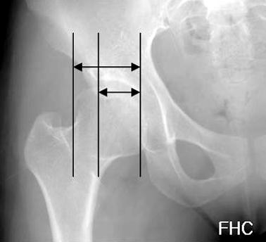 Finally to check the medialization of the femoral head, the distance between symphysis pubis and the femoral head was compared. Fig. 2.