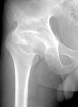 (A) Preoperative radiograph shows deformed femoral head, inclination of acetabulum and shollow acetabular coverage due to LCP sequelae.