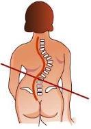 척추측만증 : 몸통이틀어지면서허리가옆으로휘어지는병이다.